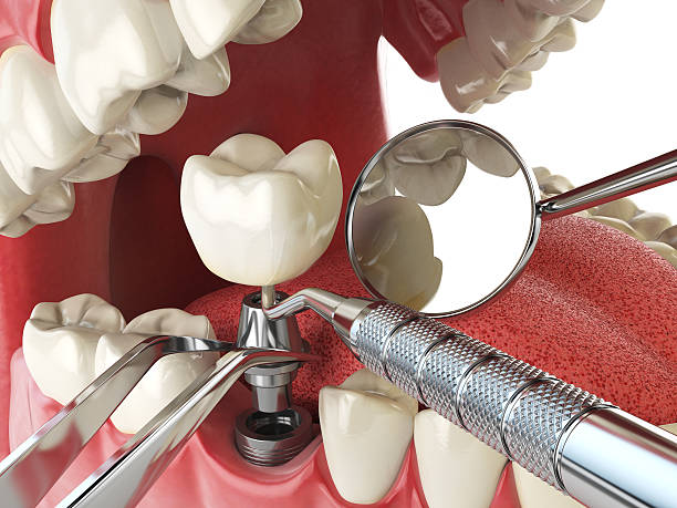 Best Emergency Tooth Extraction in Countryside, VA